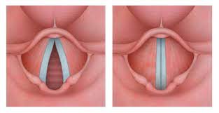 اختلال عملکرد تارهای صوتی (Vocal Cord Dysfunction)